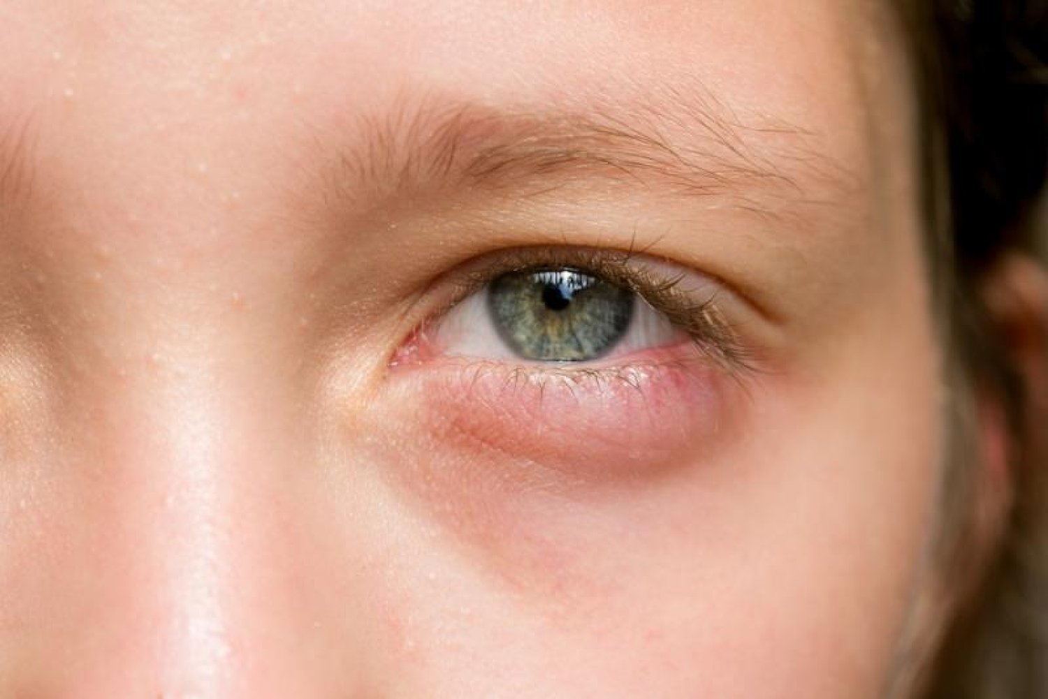 علاج انتفاخ العينين